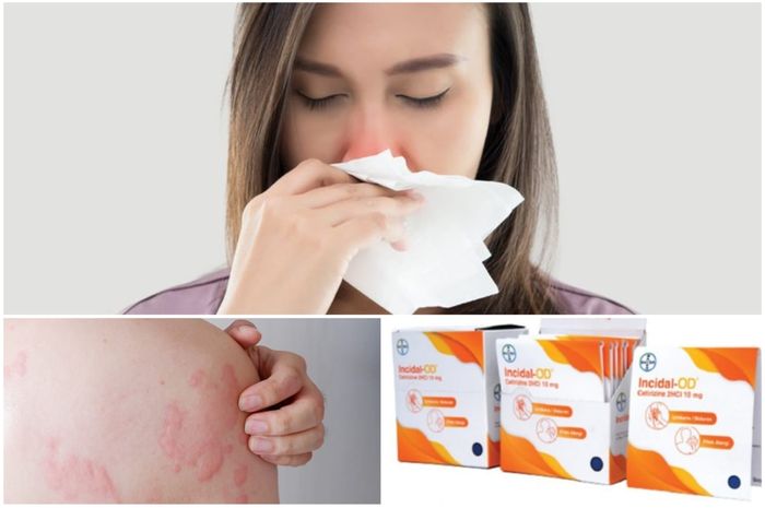 Obat Apa Yang Bisa Mengatasi Alergi Parah